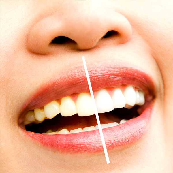 Zahnbleaching mit Wellness Gutschein genieen